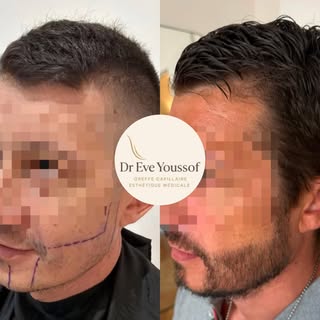 La greffe de barbe 🧔🏻‍♂️

➖ La greffe de barbe est une technique qui permet de redessiner, densifi