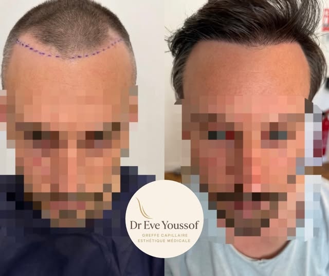 ✅ Correction des golfes pour redessiner harmonieusement la ligne frontale et le contour du visage.

