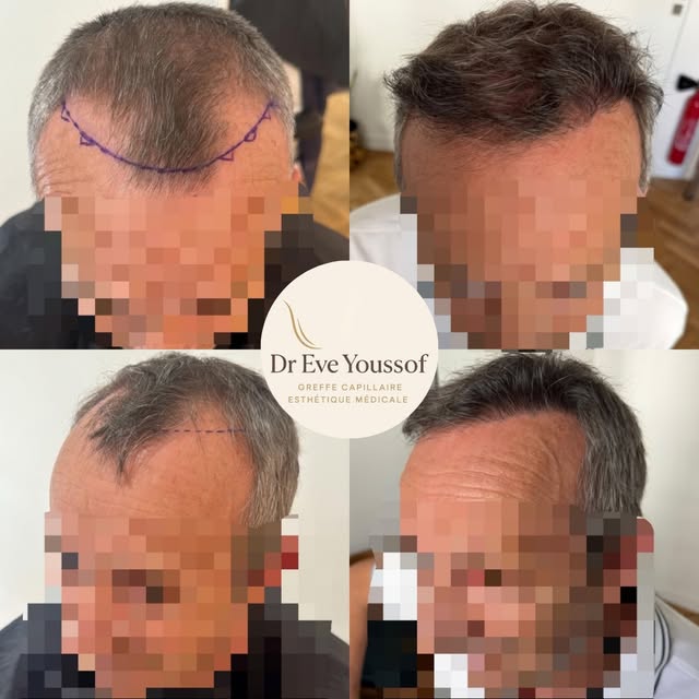 ➡️ Une ligne frontale pensée pour harmoniser le visage.

✅ Correction ciblée des golfes et redéfinit