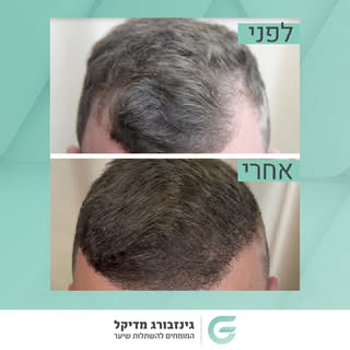אחרי הטיפול אצל גינזבורג מדיקל, אי אפשר לחזור אחורה.
צפו בלקוחות המרוצים שלנו >> 🔗 בביו!
#השתלתשיער