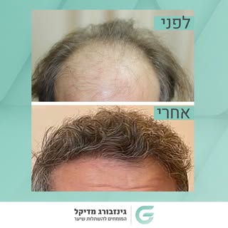 ד״ר אלכס גינזבורג יודע לחולל מ-ה-פ-ך!
צפו בלקוחות המרוצים שלנו >> 🔗 בביו!
#השתלתשיער #השתלותשיער #ה