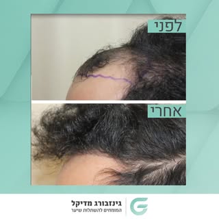 עבודה מקצועי ללא רבב. 
צפו בלקוחות המרוצים שלנו >> 🔗 בביו!
#השתלתשיער #השתלותשיער #השתלתשיערלגברים