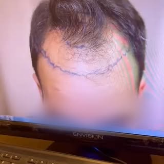 בלי קסמים, בלי פילטרים – רק השתלה מוצלחת באמת.
ד”ר גינזבורג וצוותו מחזירים לך את הביטחון בשיער.
בדיק