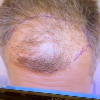 שיער מלא מתחיל בהחלטה אחת קטנה!
ד”ר גינזבורג כאן בשבילך.
#גינזבורגמדיקל #שיערמושלם