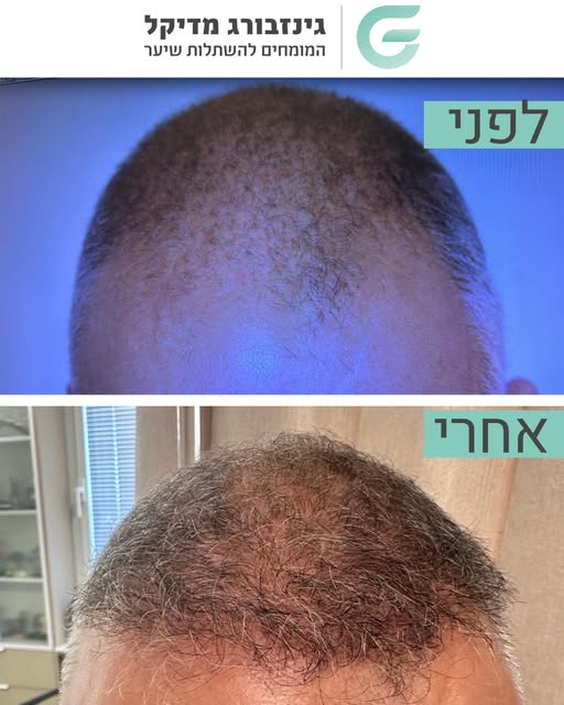 לפעמים לא צריך מילים.
רק לראות את התוצאה. 👇

#השתלת_שיער #לפני_ואחרי #דראלכסגינזבורג