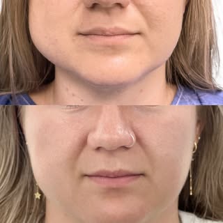Facial asymmetry is completely normal, but for some patients, improving balance and definition can h