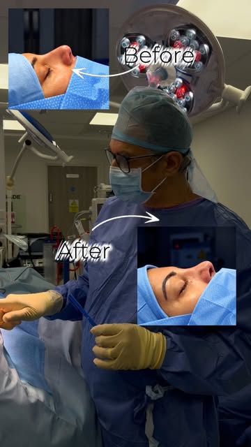 Let’s go behind the theatre doors and discover the art of Rhinoplasty 💉✨

Led by Operating Surgeon 