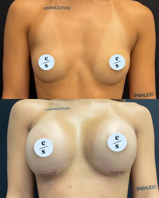 Considering breast augmentation? ✨

Operating Surgeon: Professor Ertan Erel 🥼

Whether you’re looki