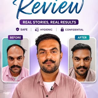 “Real Patient. Real Experience. Real Confidence.” ✨
Hair Transplant ke baad hamare patient ka experi