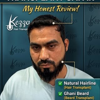 Patient real results 
Happy patient 

#haircare #hairtransplant #prp #beardtransplant #viralreel