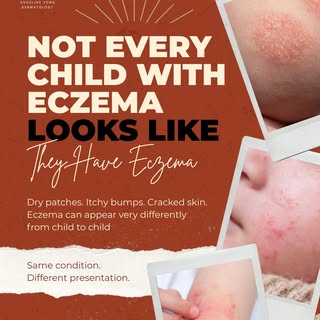 Same condition, different presentation. Eczema in kids doesn't always look the way you'd expect - dr