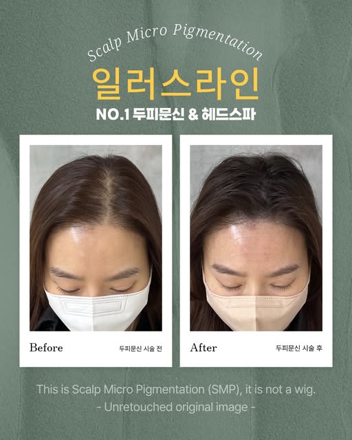 앞에서 본 두피문신 전후모습

길었던 탈모 스트레스 기간을
종결시키고 자연스럽게 채워드렸습니다.
_________________________

강남 일러스라인 대표도 받았습니다!