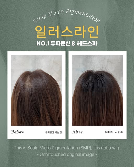 출산후 머리숱이 줄어들었던게 고민이셨던 고객님께 두피문신으로
깔끔하게 채워드렸습니다.

(샵 이전할때 전샵 이사를 마친 상태에서
베드만 있던 환경에서도 저를 믿고 
선택해주셨었어요