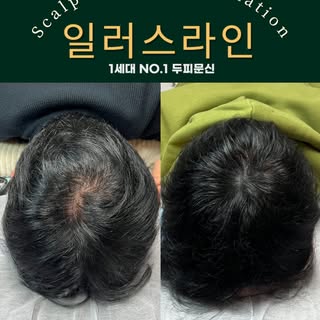 탈모로 인해 비어있던 정수리가
채워지는 탈모 두피문신

일러스라인에서 고객님께
새 삶을 선물해드렸습니다.
_________________________

강남 일러스라인 대표도 받