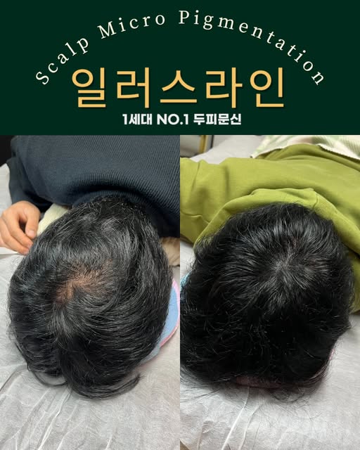 어떤 위치에서 봐도 
탈모가 없었던 것처럼
두피문신 해드렸습니다.
_________________________

강남 일러스라인 대표도 받았습니다!

예약 문의는 프로필 상단에 