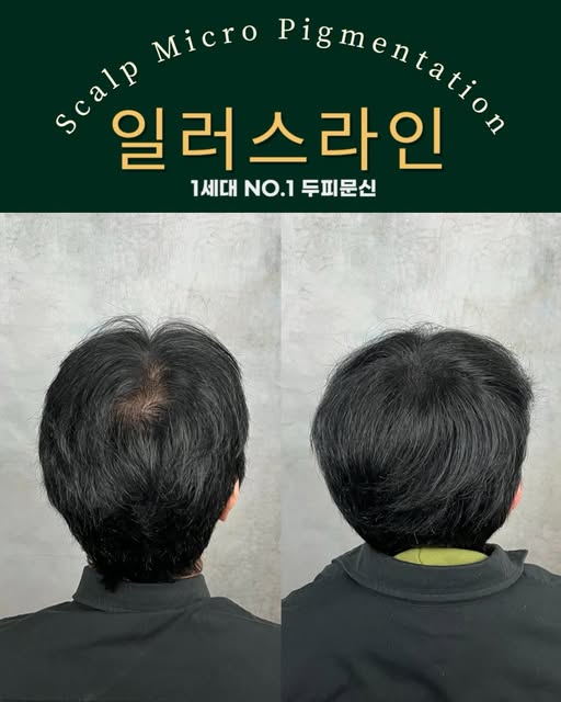 탈모로 인해서 긴시간 스트레스
받으셨던 고객님의 정수리를
탈모가 없었던것처럼
두피문신 해드렸습니다.
_________________________

강남 일러스라인 대표도 받았습니