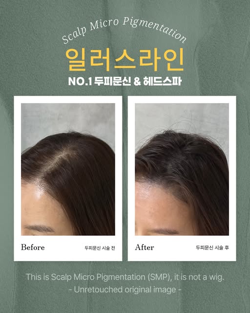 어떤 위치에서봐도
탈모가 없었던것처럼
만들어드렸습니다!
_________________________

강남 일러스라인 대표도 받았습니다!

예약 문의는 프로필 상단에 
카카오채널