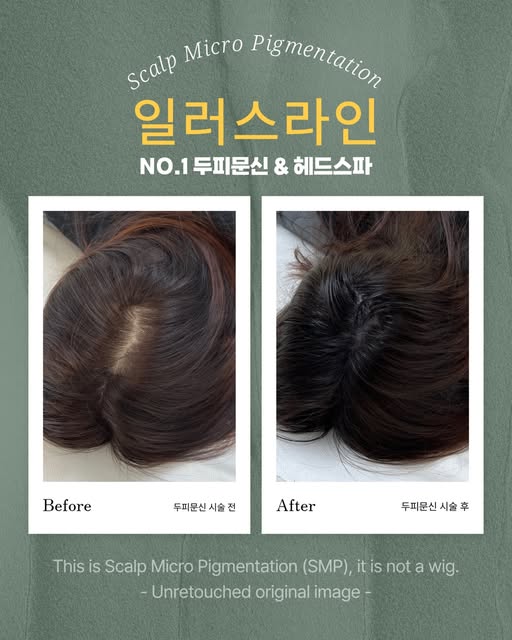 달라진 가르마에 만족한 고객님.
전 모습또한 앞쪽 진행후 찍은 사진이라
된곳 안된곳 차이가 보입니다!

탈모로 인하여 줄어들은
머리숱이 고민이시라면
두피문신 전문업체
일러스라인으로