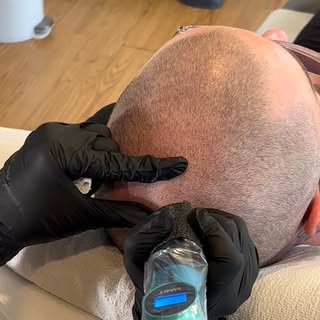 Scalp Micropigmentation (SMP) is a non-invasive treatment that creates the illusion of natural looki
