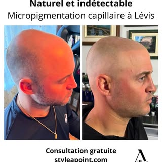 #micropimentationcapillaire #calvitie #smp #cheveuxclairsemés #pertecheveux