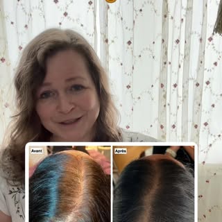 #micropimentationcapillaire #cheveuxclairsemés #pertecheveux #calvitie #smp