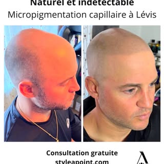 #micropimentationcapillaire #calvitie #cheveuxclairsemés #pertecheveux #smp