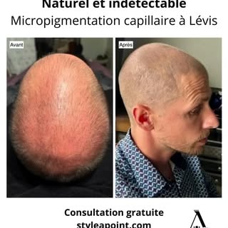 #micropimentationcapillaire #calvitie #cheveuxclairsemés #pertecheveux #smp