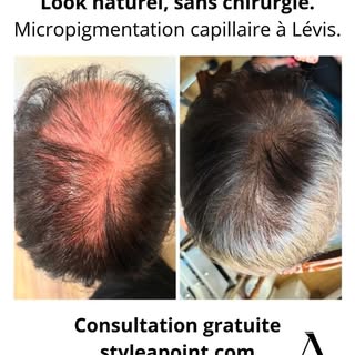 #micropimentationcapillaire #cheveuxclairsemés #calvitie #pertecheveux #smp