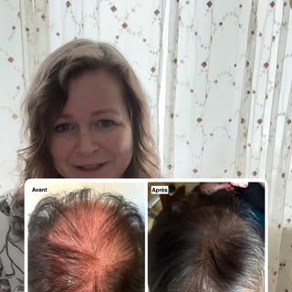 #cheveuxclairsemés #micropimentationcapillaire #pertecheveux #calvitie #smp