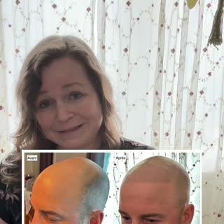 #micropimentationcapillaire #calvitie #cheveuxclairsemés #pertecheveux #smp