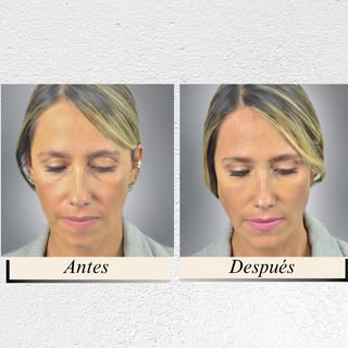 Consigue 15 años menos con el Top Model Look en tiempo Real. 👩🏻‍⚕️

Este es el antes y después de 