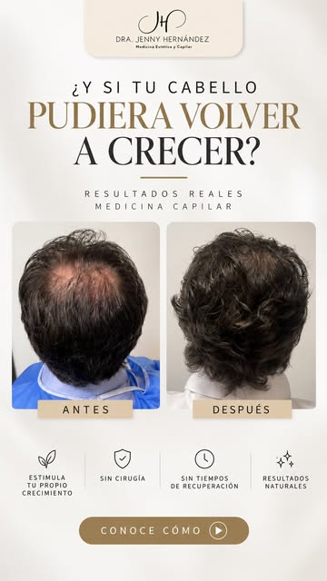 ✨ ¿30,000 cabellos sin trasplante? Mira estos resultados top. Con nuestro Tratamiento PRIME estimula