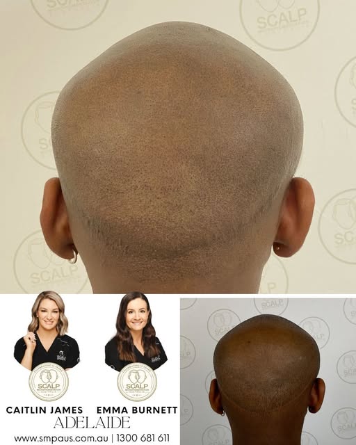 What a change thanks to Scalp MicroPigmentation! Our client saw Caitlin and Emma from Adelaide for d