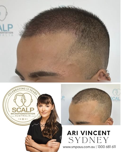 SMP isn't just for shaved scalps, but our popular crew length treatments can increase the look of de