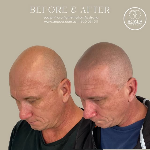 Can you believe this is Scalp MicroPigmentation? 

We love a great transformation like this, a new h