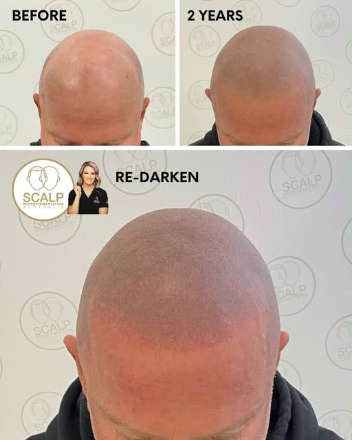 The front view…. After a Redarkening session, the scalp appears slightly red for a day or so. Re-dar