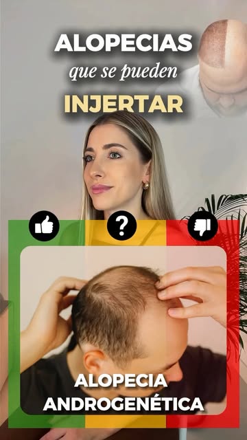 No todas las alopecias se pueden trasplantar. 👀

Y aunque muchas veces pensamos en el trasplante ca