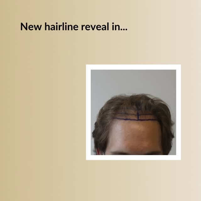 Restore Your Youthful Hairline!

Check the video below and see why guys choose Dr. Rahal.

✅The reco