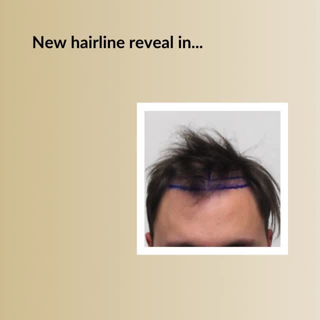 Restore Your Youthful Hairline!

Check the video below and see why guys choose Dr. Rahal.

✅The reco