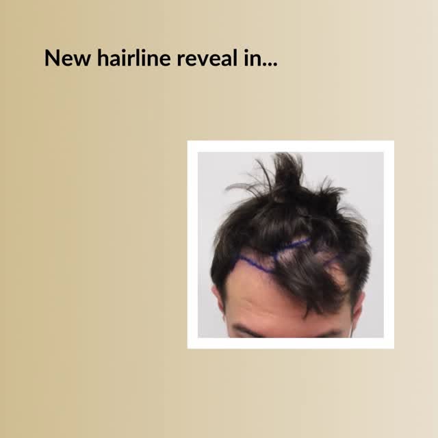 Restore Your Youthful Hairline!

Check the video below and see why guys choose Dr. Rahal.

✅The reco