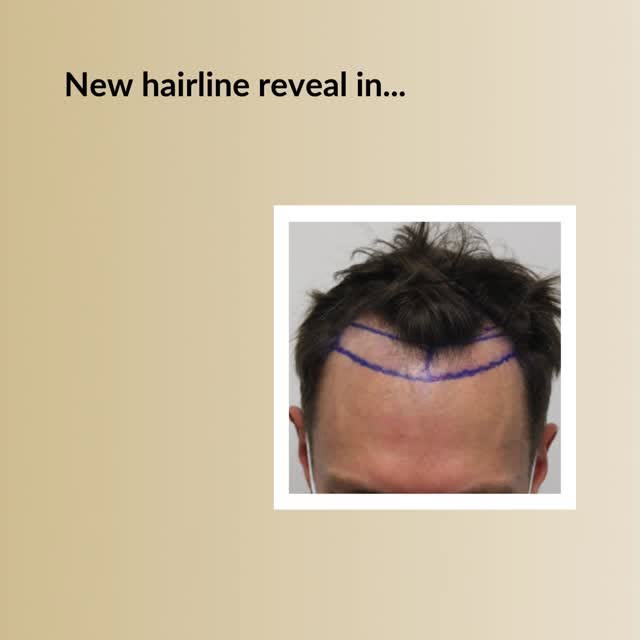Restore Your Youthful Hairline!

Check the video below and see why guys choose Dr. Rahal.

✅The reco
