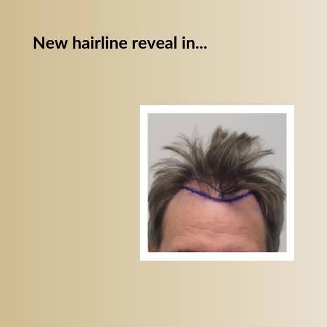Restore Your Youthful Hairline!

Check the video below and see why guys choose Dr. Rahal.

✅The reco