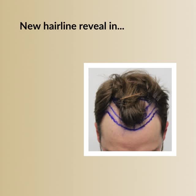 Restore Your Youthful Hairline!

Check the video below and see why guys choose Dr. Rahal.

✅The reco