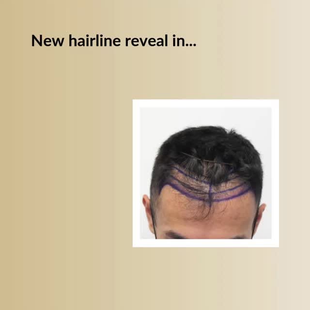 Restore Your Youthful Hairline!

Check the video below and see why guys choose Dr. Rahal.

✅The reco