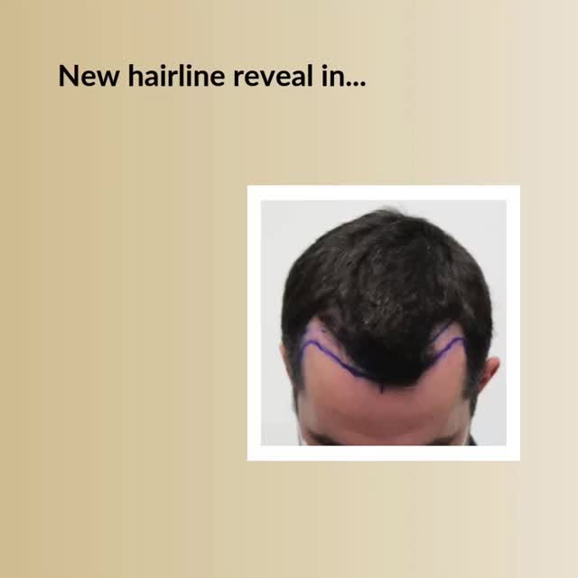 Restore Your Youthful Hairline!

Check the video below and see why guys choose Dr. Rahal.

✅The reco