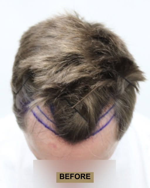 1,447 grafts, performed by Dr. Rahal — swipe to see 8 months of growth.

#fuehairtransplant #hairtra