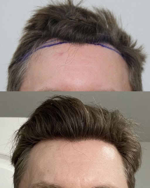 That line is where his new hairline was designed. 

8 months later, here's what it grew into.

If yo