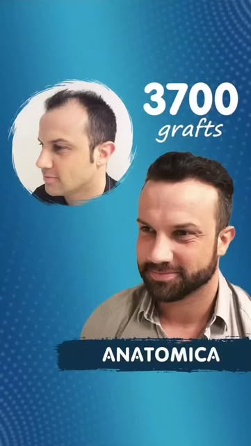 📍 3700 Follicular Units – Anatomica Clinic

✨ Thicker, stronger, and more natural-looking hair with