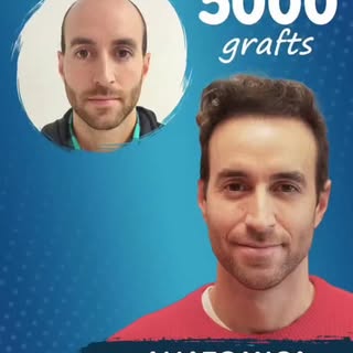 📍 5000 Follicular Units – Anatomica Clinic

✨ Achieve denser, stronger, and natural-looking hair wi