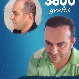 📍 3600 Follicular Units – Anatomica Clinic

✨ Achieve a fuller and more natural look with 3600 graf